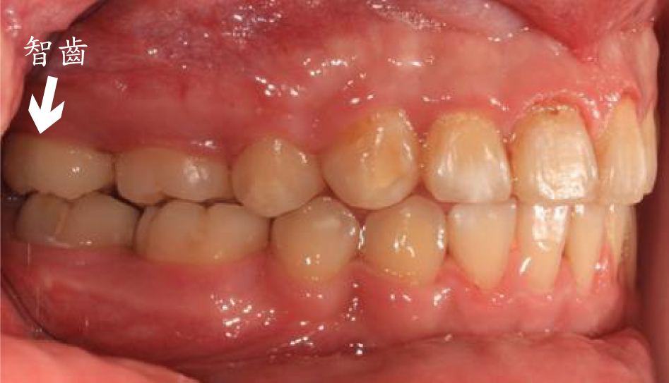 牙齒矯正案例