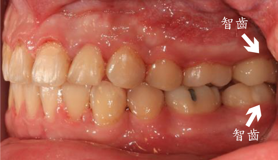 牙齒矯正案例